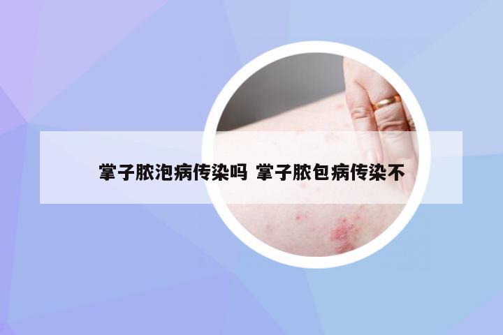 掌子脓泡病传染吗 掌子脓包病传染不