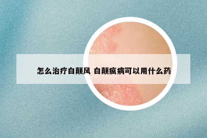 怎么治疗白颠风 白颠疯病可以用什么药