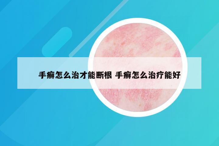 手癣怎么治才能断根 手癣怎么治疗能好