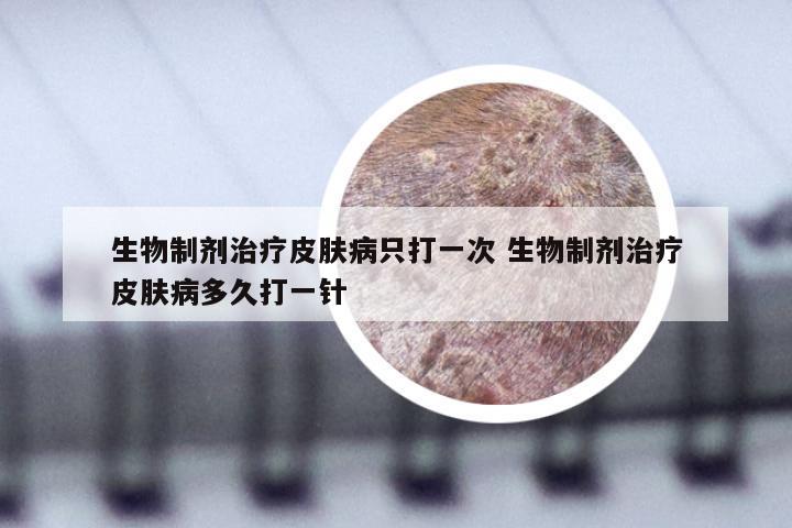 生物制剂治疗皮肤病只打一次 生物制剂治疗皮肤病多久打一针