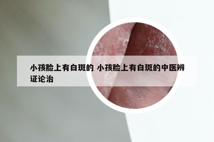 小孩脸上有白斑的 小孩脸上有白斑的中医辨证论治