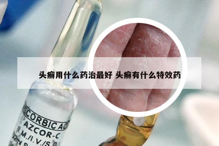 头癣用什么药治最好 头癣有什么特效药