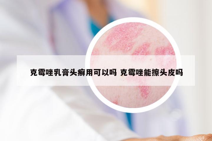 克霉唑乳膏头癣用可以吗 克霉唑能擦头皮吗