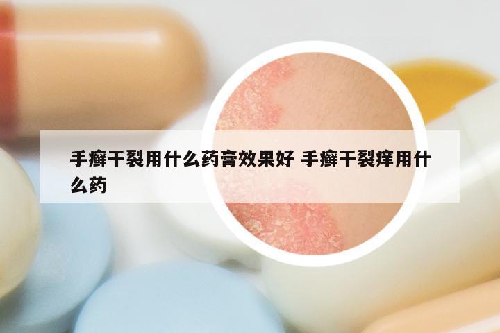 手癣干裂用什么药膏效果好 手癣干裂痒用什么药