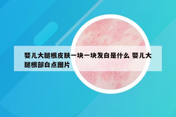 婴儿大腿根皮肤一块一块发白是什么 婴儿大腿根部白点图片