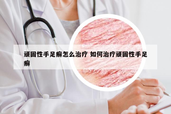 顽固性手足癣怎么治疗 如何治疗顽固性手足癣