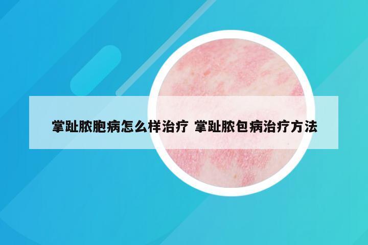 掌趾脓胞病怎么样治疗 掌趾脓包病治疗方法