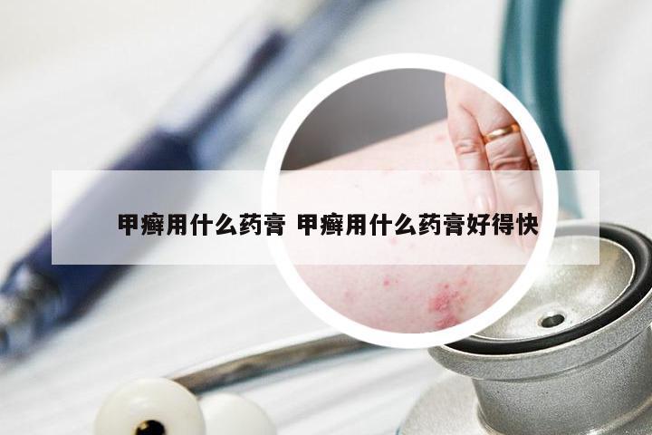 甲癣用什么药膏 甲癣用什么药膏好得快