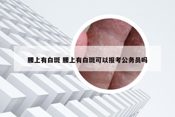 腰上有白斑 腰上有白斑可以报考公务员吗