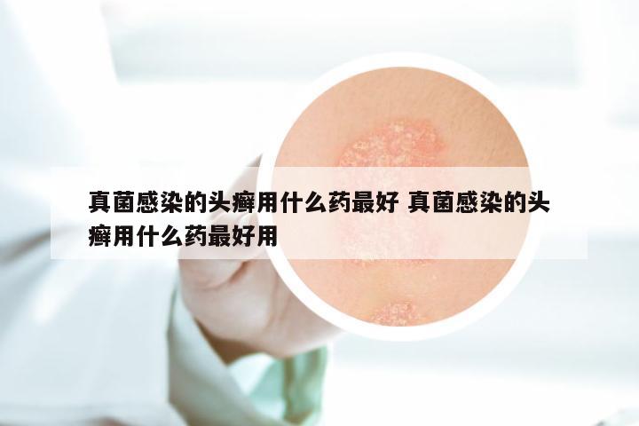 真菌感染的头癣用什么药最好 真菌感染的头癣用什么药最好用