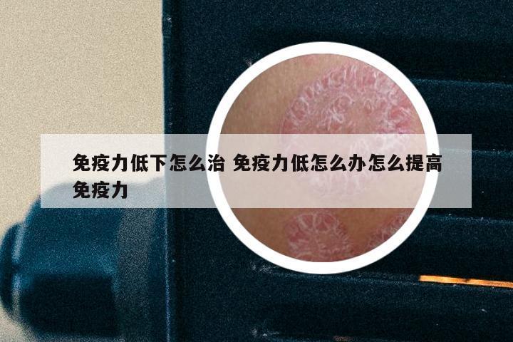 免疫力低下怎么治 免疫力低怎么办怎么提高免疫力