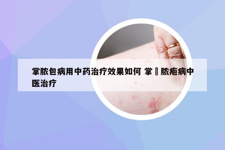 掌脓包病用中药治疗效果如何 掌踀脓疱病中医治疗