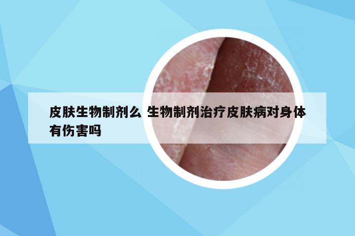 皮肤生物制剂么 生物制剂治疗皮肤病对身体有伤害吗