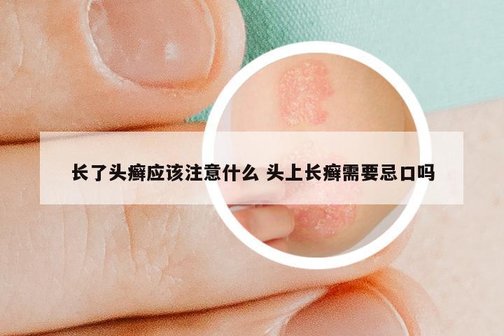 长了头癣应该注意什么 头上长癣需要忌口吗