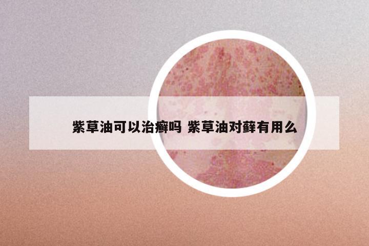 紫草油可以治癣吗 紫草油对藓有用么