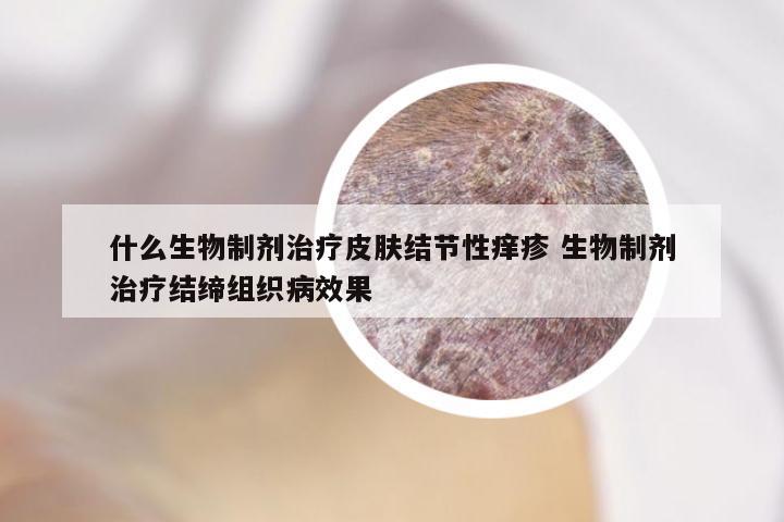 什么生物制剂治疗皮肤结节性痒疹 生物制剂治疗结缔组织病效果