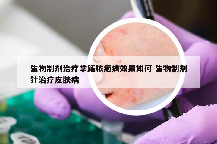 生物制剂治疗掌跖脓疱病效果如何 生物制剂针治疗皮肤病