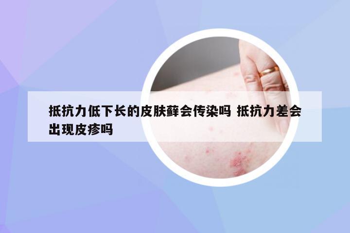 抵抗力低下长的皮肤藓会传染吗 抵抗力差会出现皮疹吗