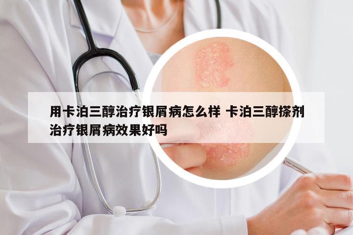 用卡泊三醇治疗银屑病怎么样 卡泊三醇搽剂治疗银屑病效果好吗