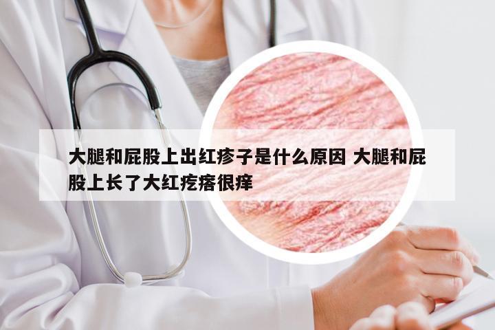 大腿和屁股上出红疹子是什么原因 大腿和屁股上长了大红疙瘩很痒