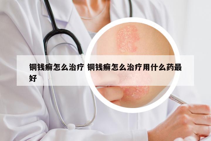 铜钱癣怎么治疗 铜钱癣怎么治疗用什么药最好