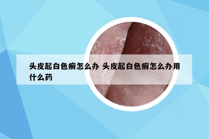 头皮起白色癣怎么办 头皮起白色癣怎么办用什么药