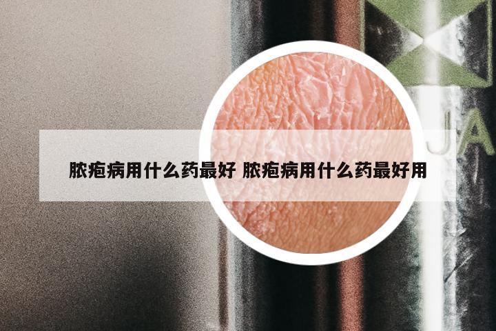 脓疱病用什么药最好 脓疱病用什么药最好用