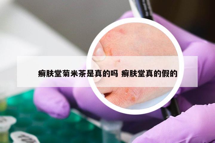 癣肤堂菊米茶是真的吗 癣肤堂真的假的