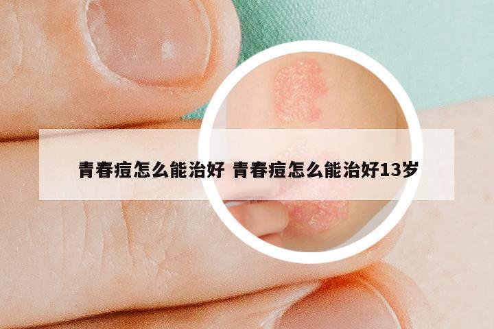 青春痘怎么能治好 青春痘怎么能治好13岁