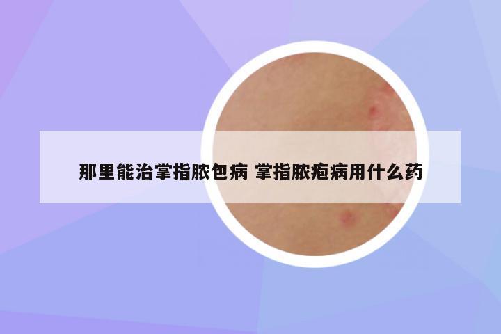 那里能治掌指脓包病 掌指脓疱病用什么药