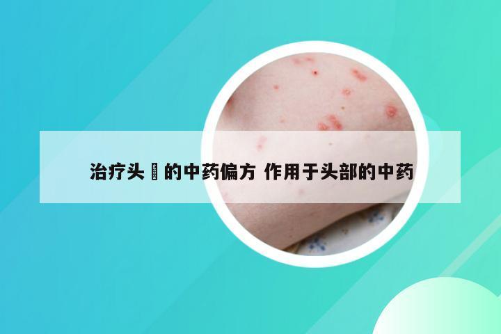 治疗头廯的中药偏方 作用于头部的中药