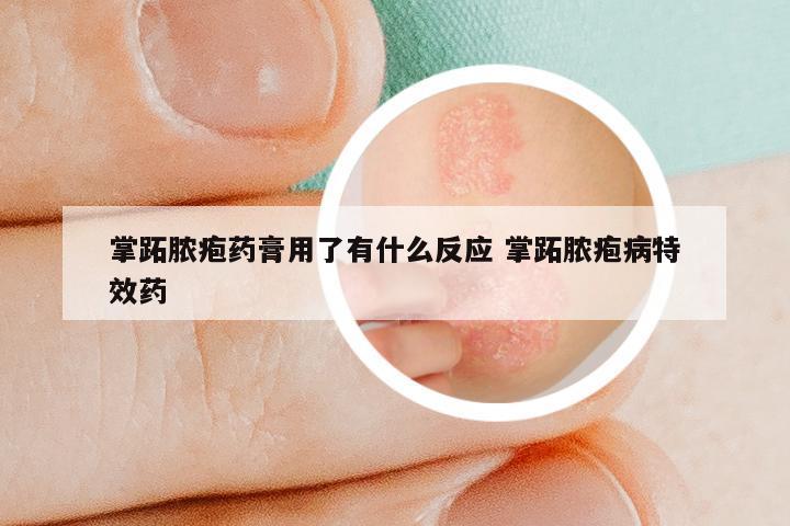 掌跖脓疱药膏用了有什么反应 掌跖脓疱病特效药