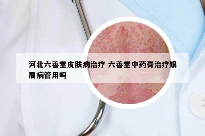 河北六善堂皮肤病治疗 六善堂中药膏治疗银屑病管用吗