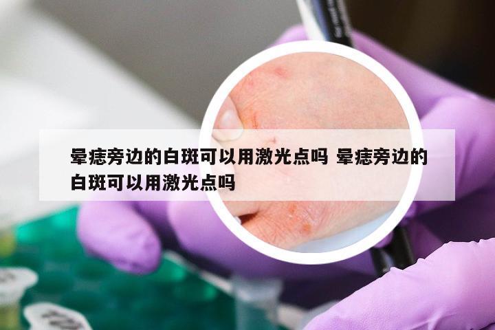 晕痣旁边的白斑可以用激光点吗 晕痣旁边的白斑可以用激光点吗