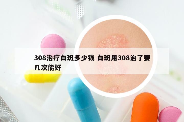 308治疗白斑多少钱 白斑用308治了要几次能好