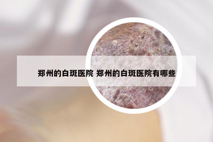 郑州的白斑医院 郑州的白斑医院有哪些