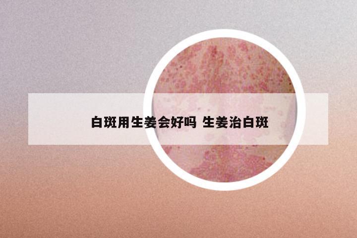 白斑用生姜会好吗 生姜治白斑