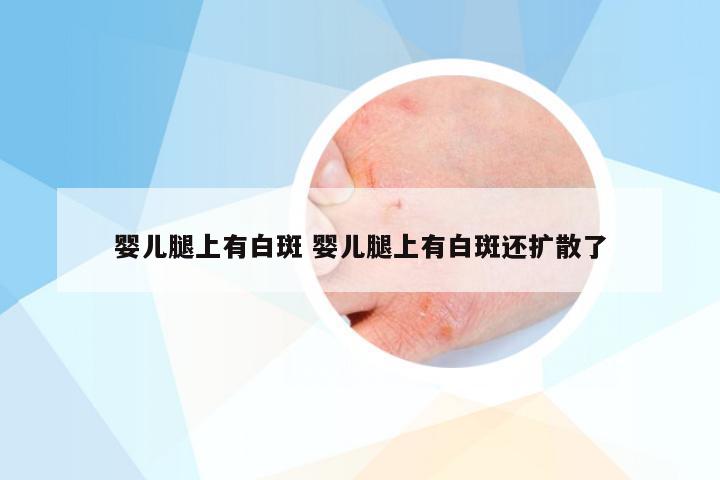 婴儿腿上有白斑 婴儿腿上有白斑还扩散了