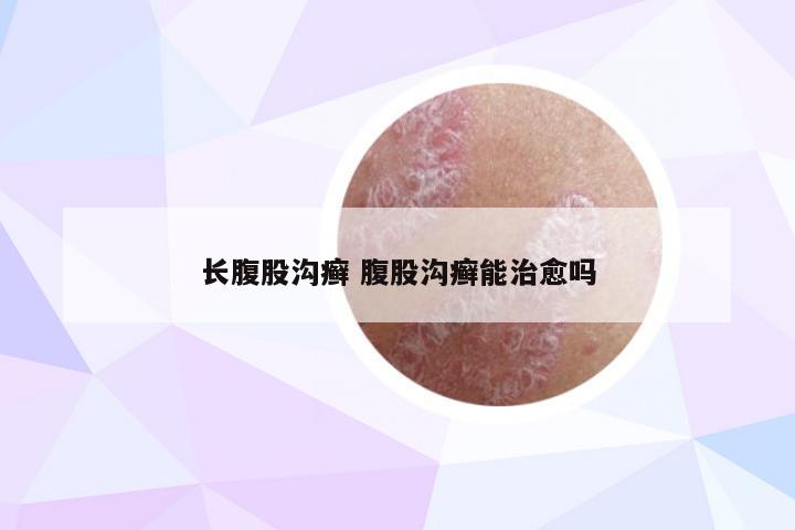 长腹股沟癣 腹股沟癣能治愈吗