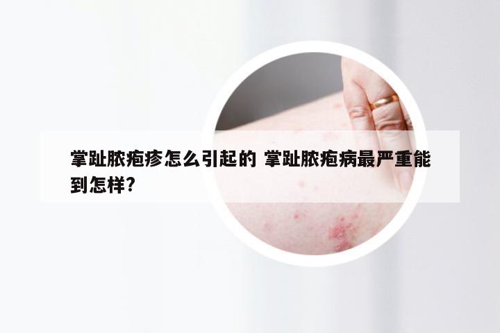 掌趾脓疱疹怎么引起的 掌趾脓疱病最严重能到怎样?