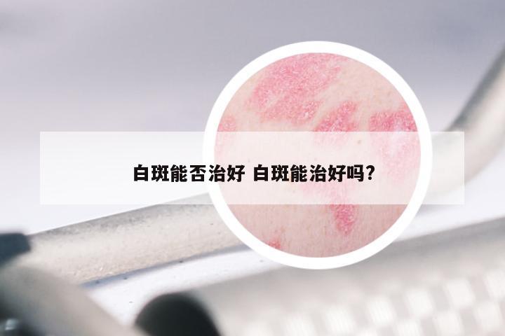 白斑能否治好 白斑能治好吗?