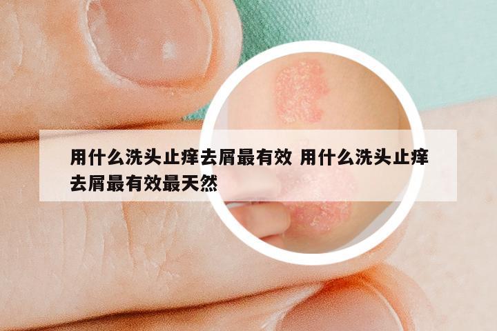 用什么洗头止痒去屑最有效 用什么洗头止痒去屑最有效最天然