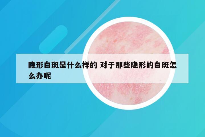 隐形白斑是什么样的 对于那些隐形的白斑怎么办呢