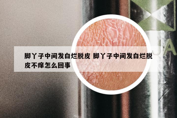 脚丫子中间发白烂脱皮 脚丫子中间发白烂脱皮不痒怎么回事