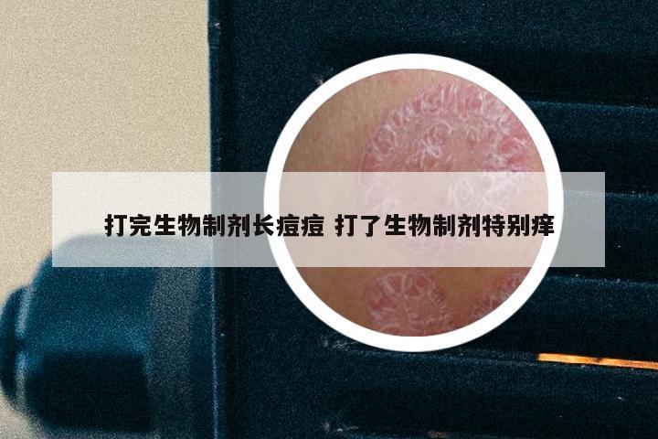 打完生物制剂长痘痘 打了生物制剂特别痒