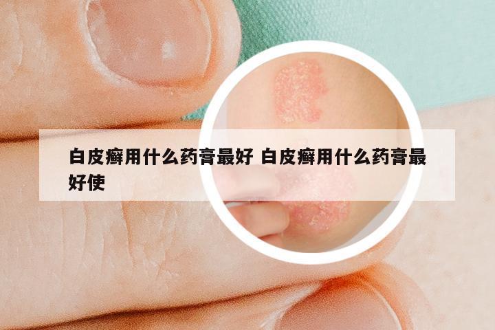 白皮癣用什么药膏最好 白皮癣用什么药膏最好使