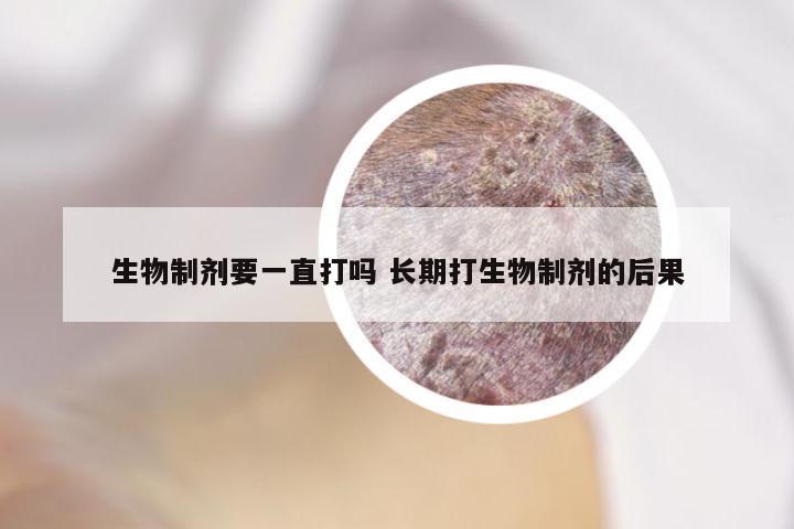 生物制剂要一直打吗 长期打生物制剂的后果