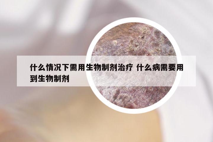 什么情况下需用生物制剂治疗 什么病需要用到生物制剂