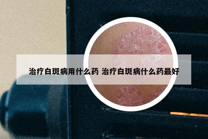 治疗白斑病用什么药 治疗白斑病什么药最好