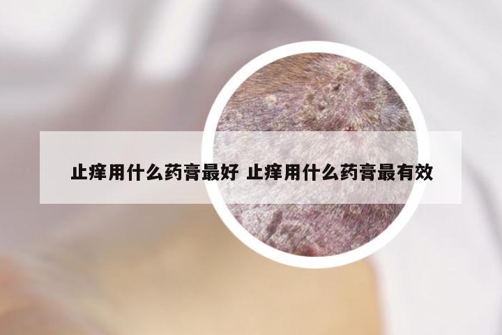 止痒用什么药膏最好 止痒用什么药膏最有效